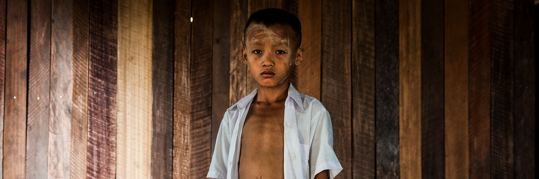 Ein Bub aus Myanmar, man sieht Narben an seinem Bauch.