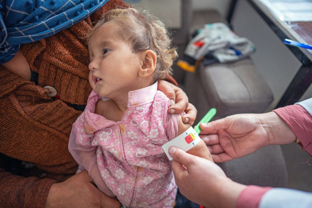 Kind in Afghanistan wird mit einem Maßband auf Mangelernährung untersucht.