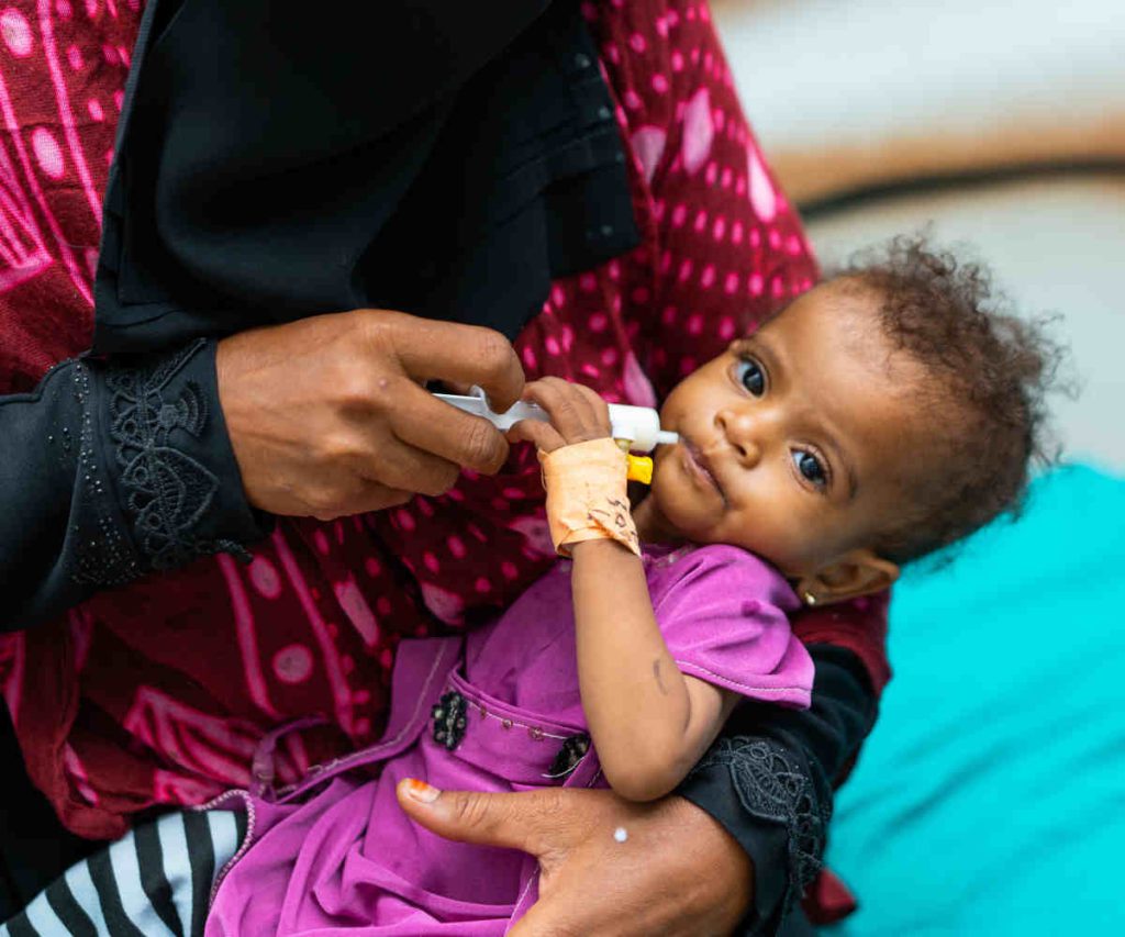 Mangelernährtes Kind im Jemen wird mit Spezialnahrung gefüttert.